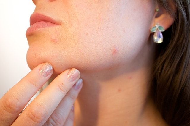 woman touching chin that has acne. 